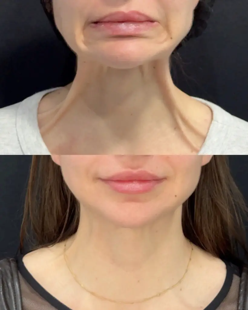 Antes e depois de uma paciente da Vence Clinic