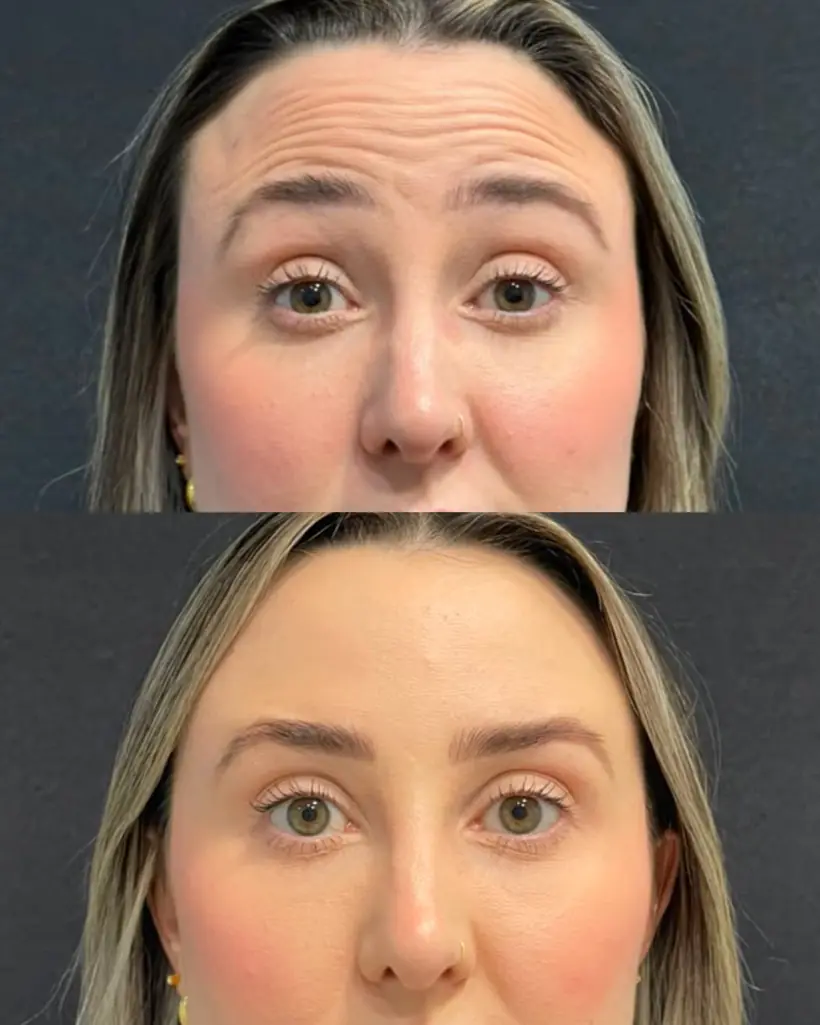 Antes e depois de uma paciente da Vence Clinic