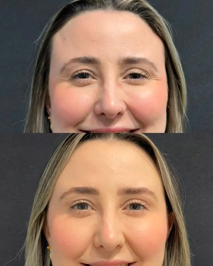 Antes e depois de uma paciente da Vence Clinic