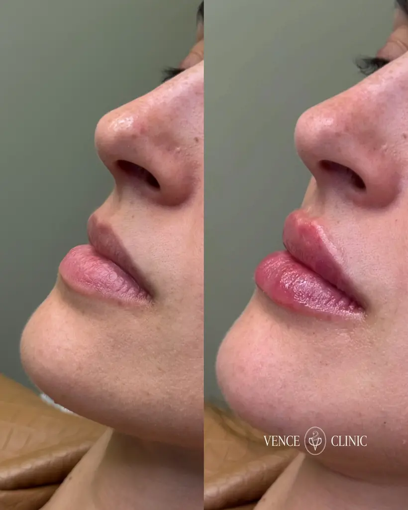 Antes e depois de uma paciente da Vence Clinic