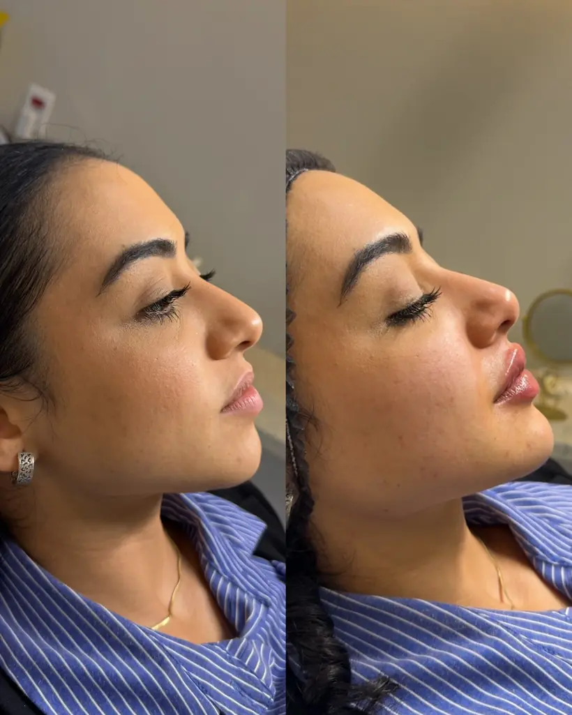 Antes e depois de uma paciente da Vence Clinic