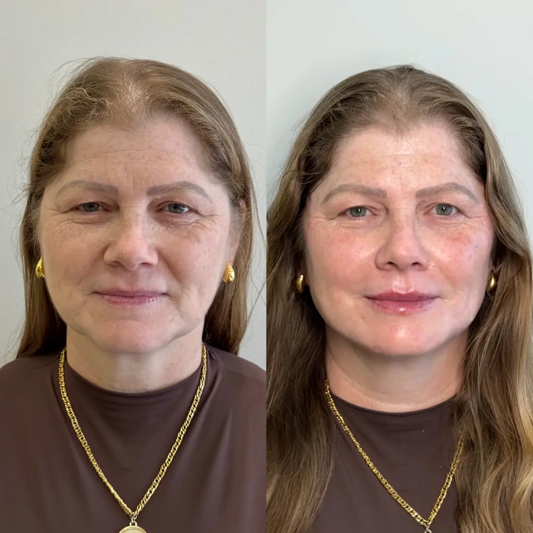 Antes e depois de uma paciente da Vence Clinic